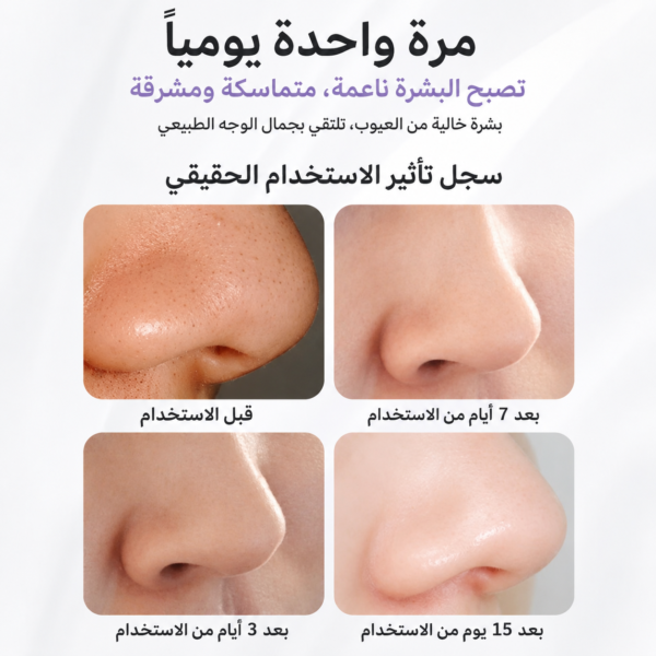 جهاز شفط الرؤوس السوداء بالمحاليل من FELMAR BEAUTY